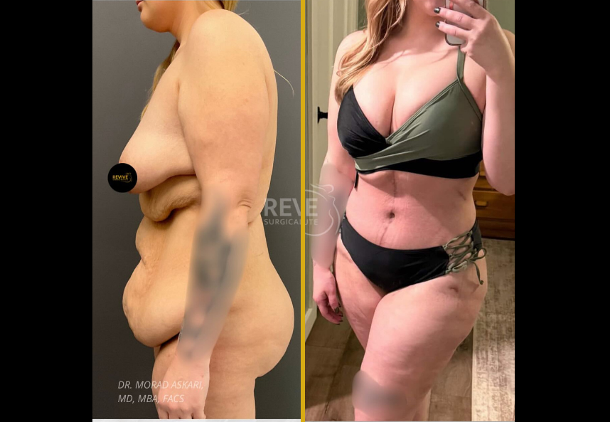 Before and after tummy tuck and breast augmentation results showing side profile and front view