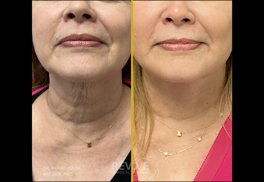 Facelift