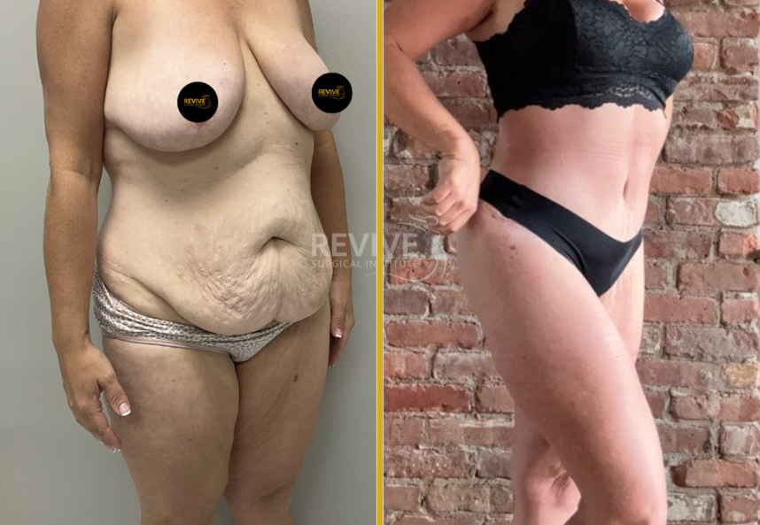 Tummy Tuck 4 (3)