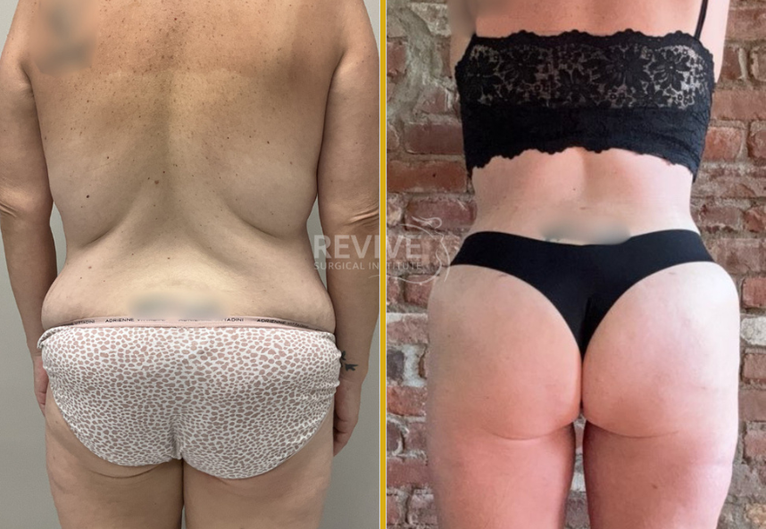 Tummy Tuck 4 (4)