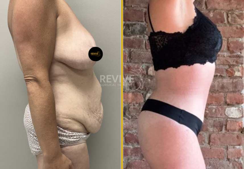 Tummy Tuck 4