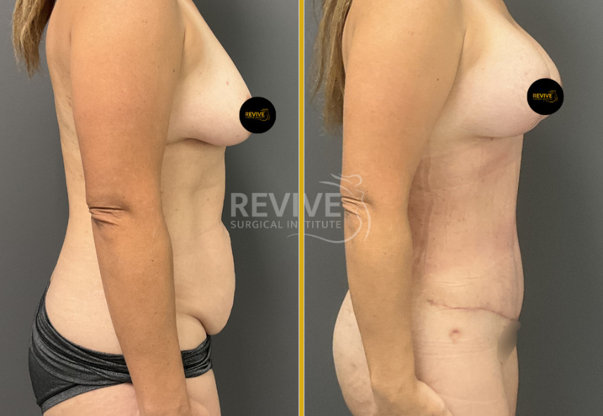 Tummy Tuck 6 (2)