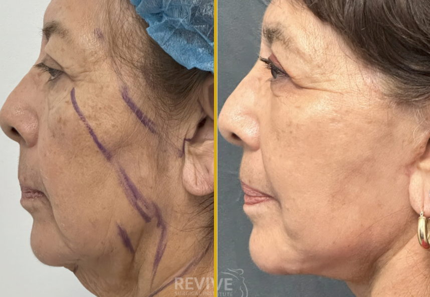 Facelift (2)