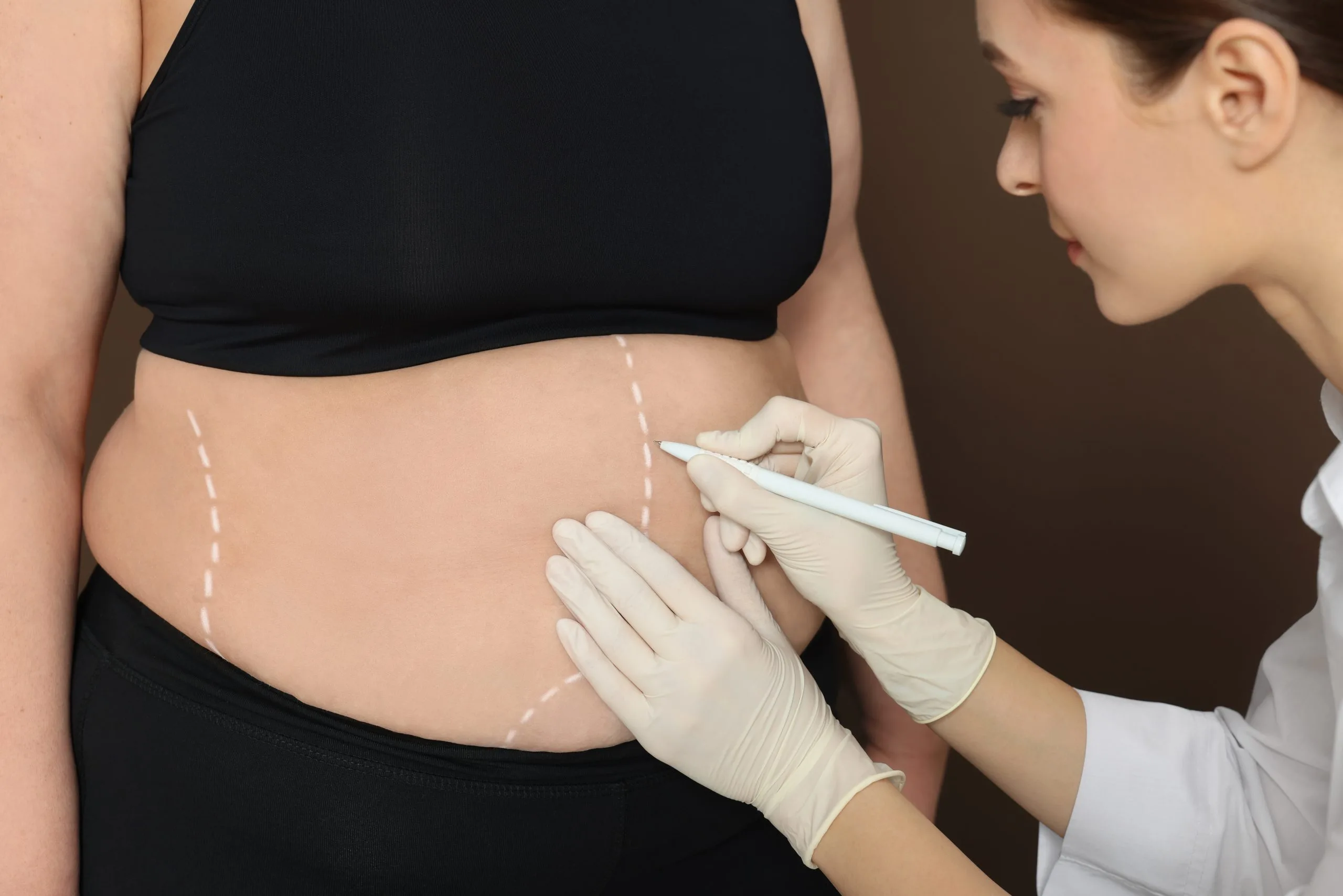 Surgeon marking abdomen with surgical pen for body contouring procedure