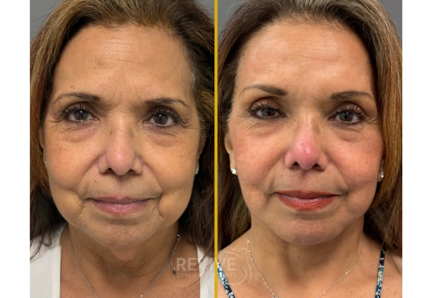 Before and after facial comparison showing reduced under-eye hollowing and improved skin texture