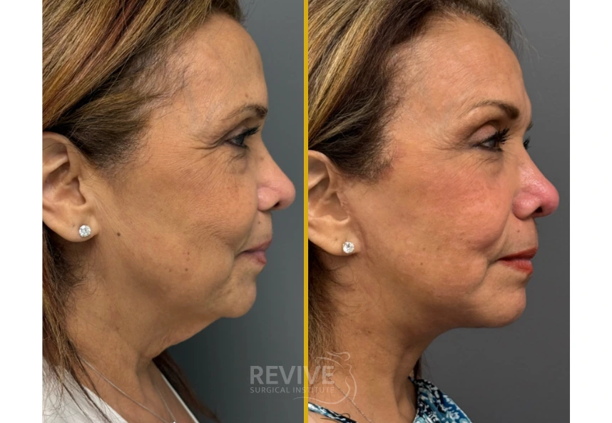 Before and after profile comparison showing improved facial contours and chin definition