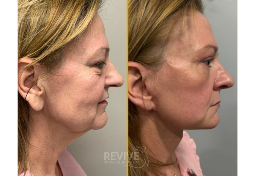 Before and after profile view showing improved jawline and neck definition