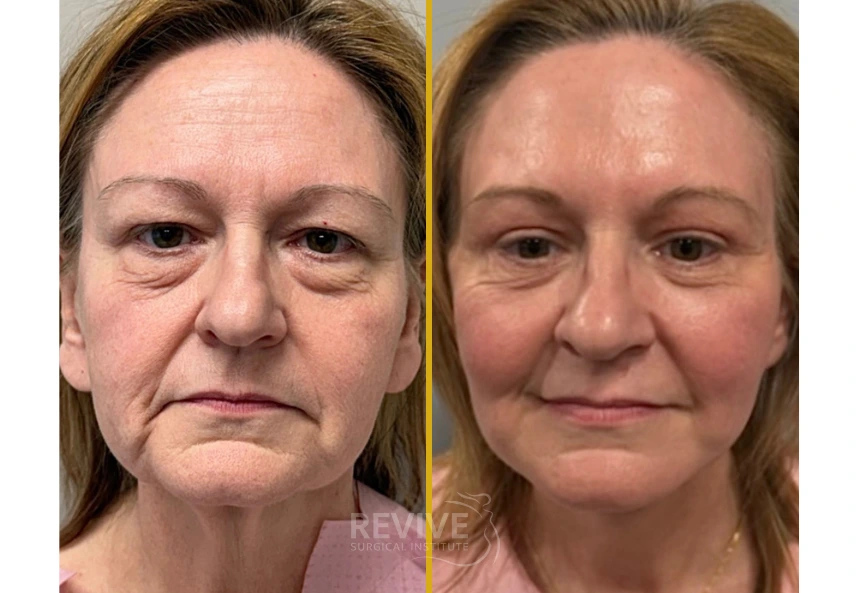 Before and after frontal view showing reduced under-eye bags and improved skin texture