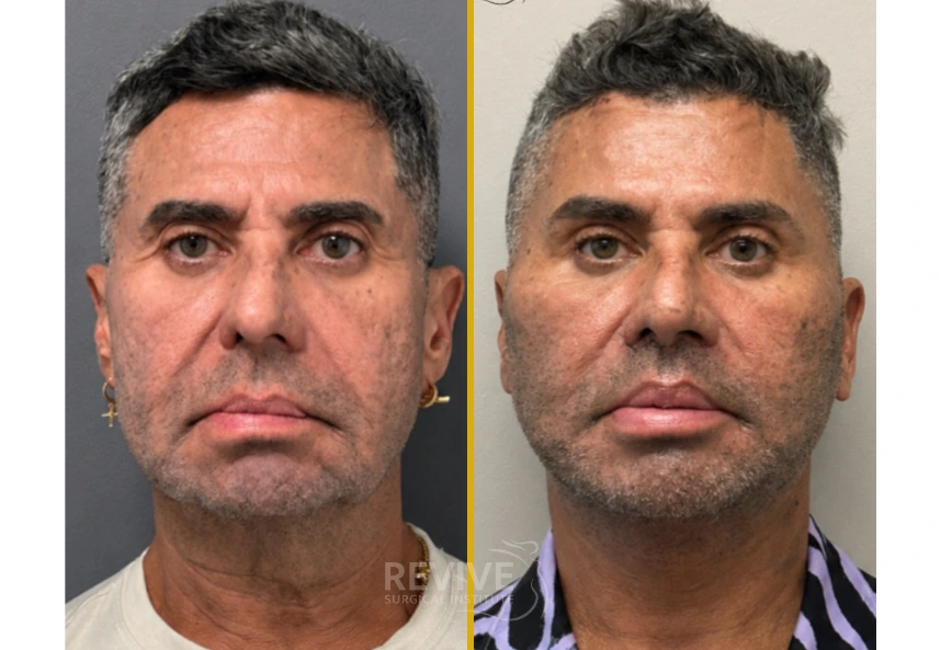 Before and after frontal view showing improved skin tone and reduced facial puffiness