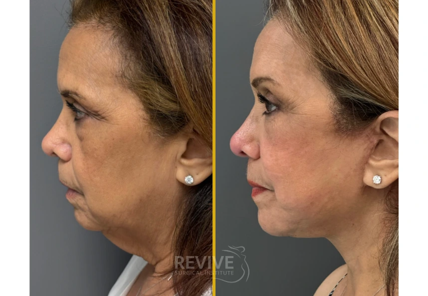 Before and after side profile comparison showing refined jawline and neck contour