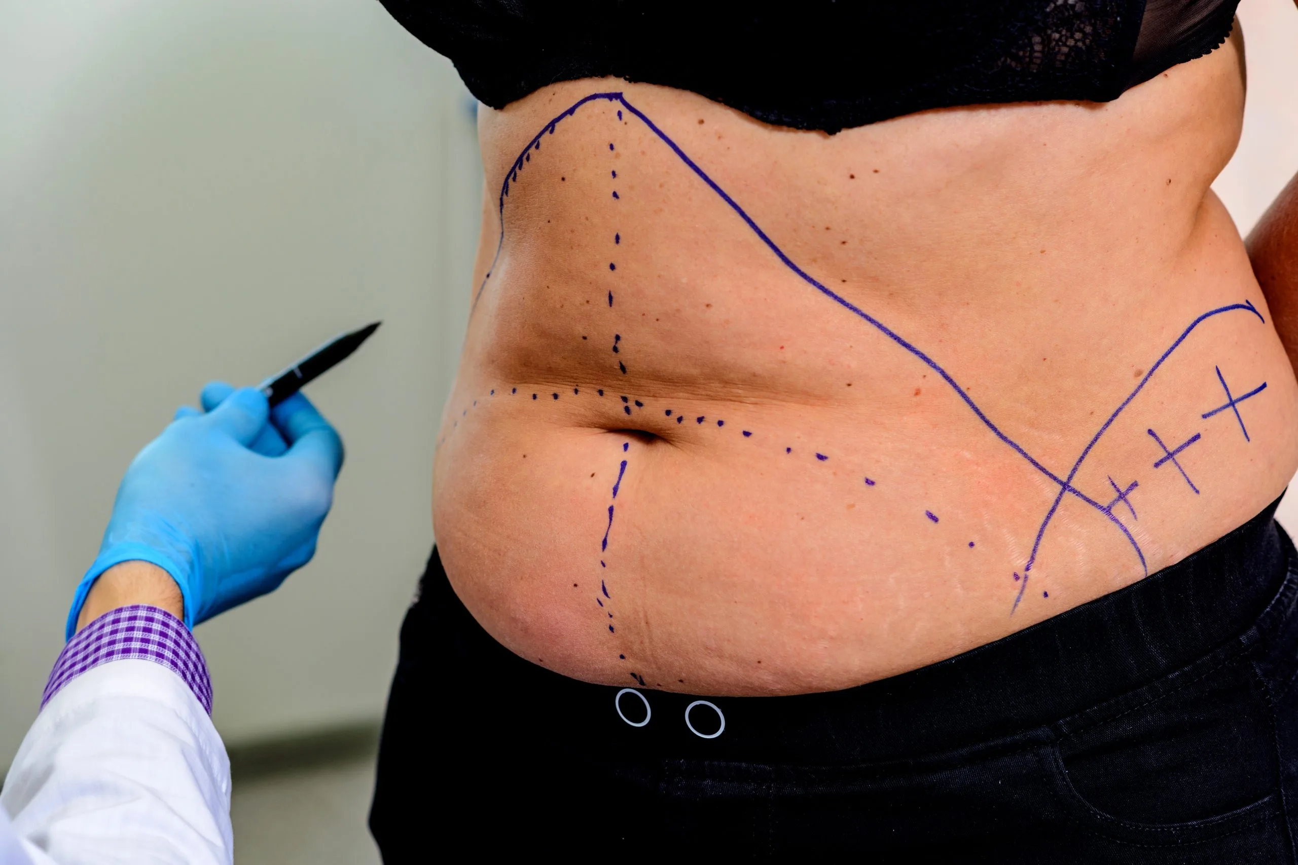 Surgeon in blue gloves marking abdomen with dotted and solid lines for surgical planning