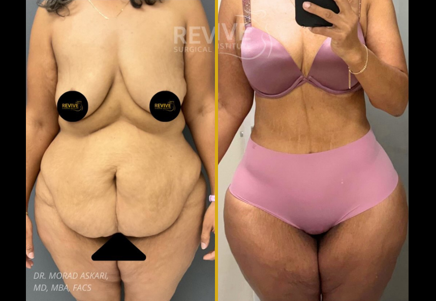 Before and after case 21: patient's torso showing body contouring results after weight loss, by Dr. Morad Askari