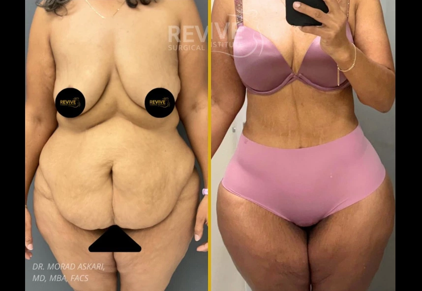Before and after case 21: patient's torso showing body contouring results after weight loss, by Dr. Morad Askari