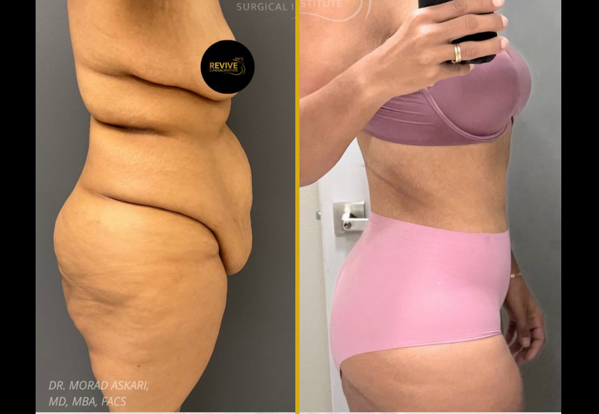 Before and after surgical body contouring following weight loss, showing reduced abdominal and lower body skin laxity