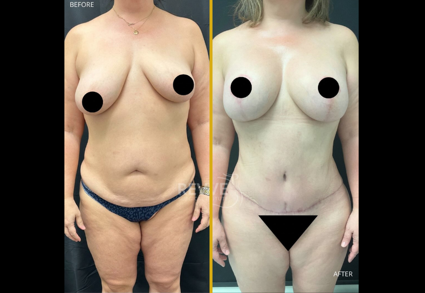 Before and after body contouring case 20: frontal view showing improved abdominal and breast contours after weight loss treatment