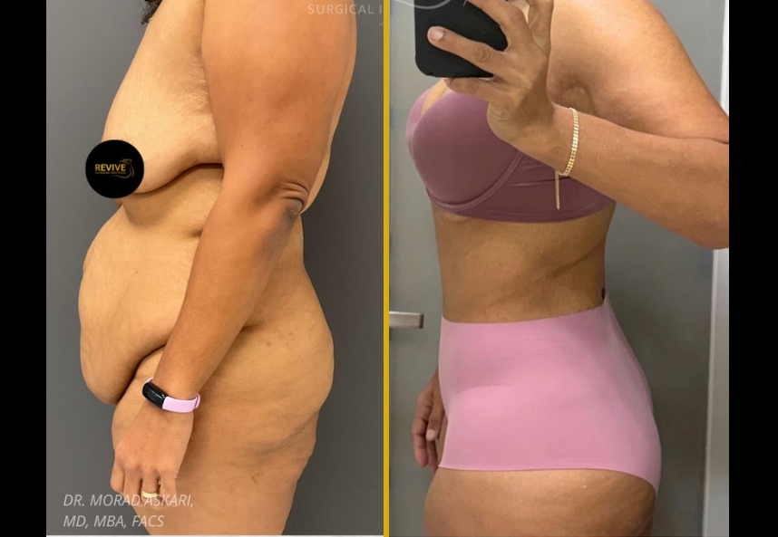Before and after body contouring results following weight loss, showing improved abdominal and torso definition