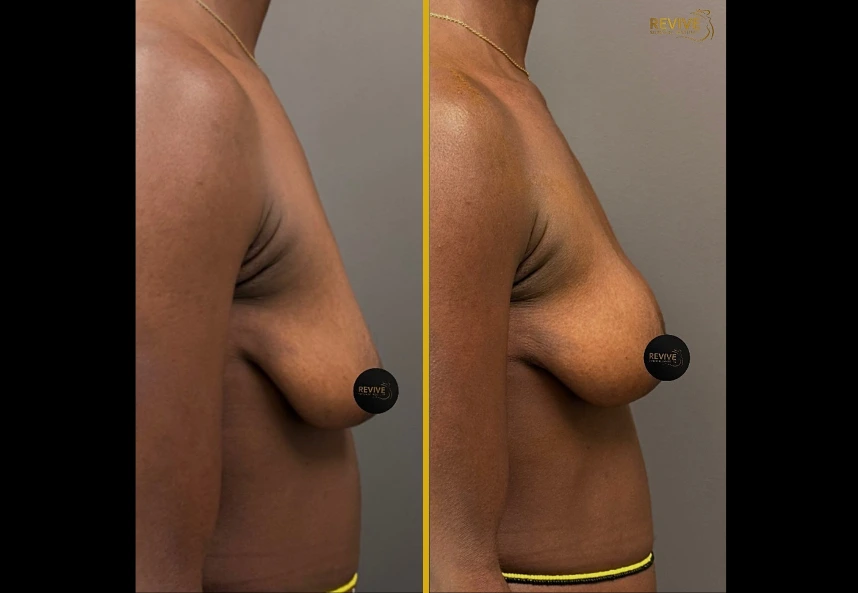 Before and after side-by-side profile view of breast augmentation results using Alloclae