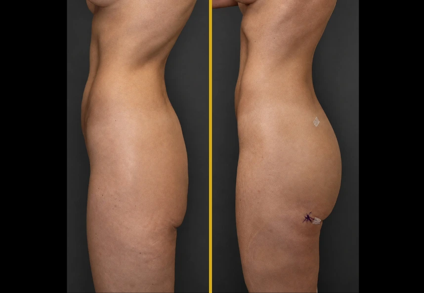 Before and after side-view comparison of buttock augmentation with Alloclae product