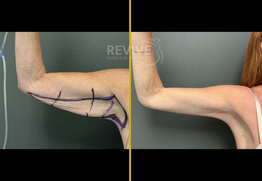 Before and after brachioplasty, arm extended showing surgical markings and reduced loose skin