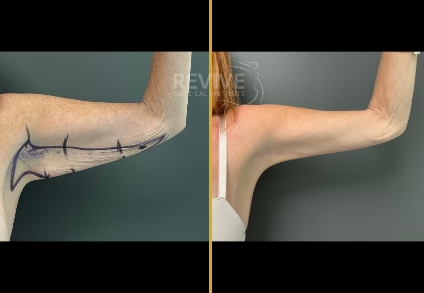 Before and after brachioplasty, arm extended showing surgical incision markings and skin tightening result