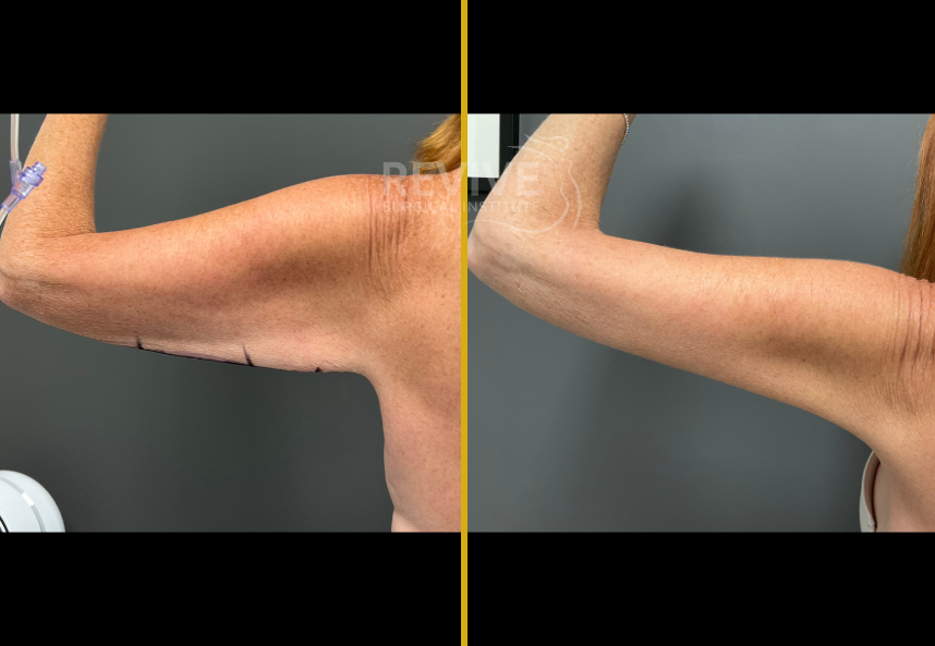 Before and after brachioplasty, arm flexed showing reduced excess skin and improved arm contour