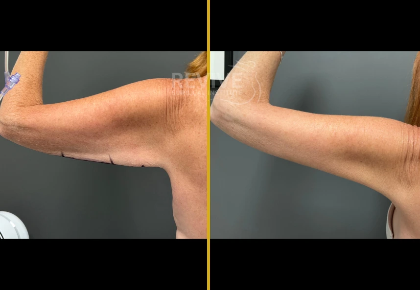 Before and after brachioplasty, arm flexed showing reduced excess skin and improved arm contour