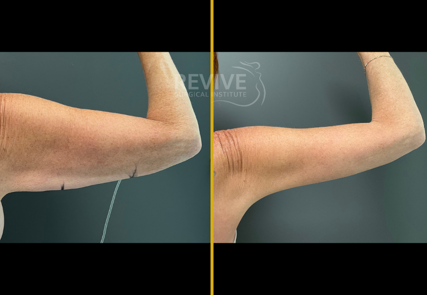 Before and after brachioplasty showing patient's arms with excess skin tightened and defined