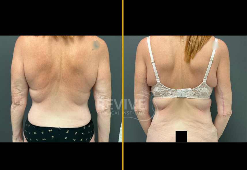 Before and after brachioplasty showing patient's back with improved arm contour and skin tightness