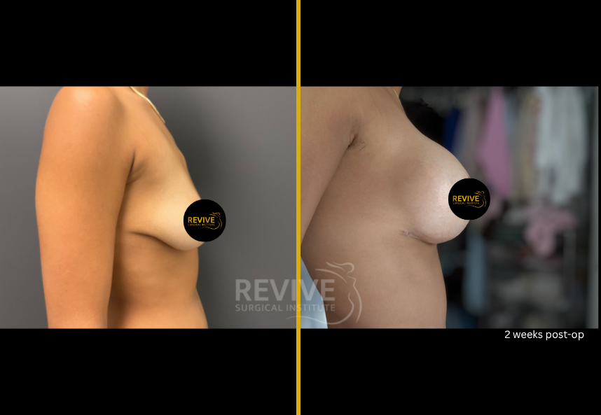 Breast Augmentation (2)