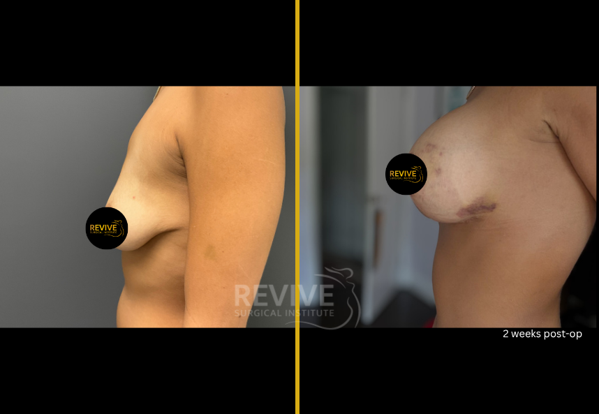 Breast Augmentation (3)