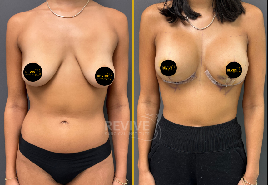 Breast Augmentation (4)