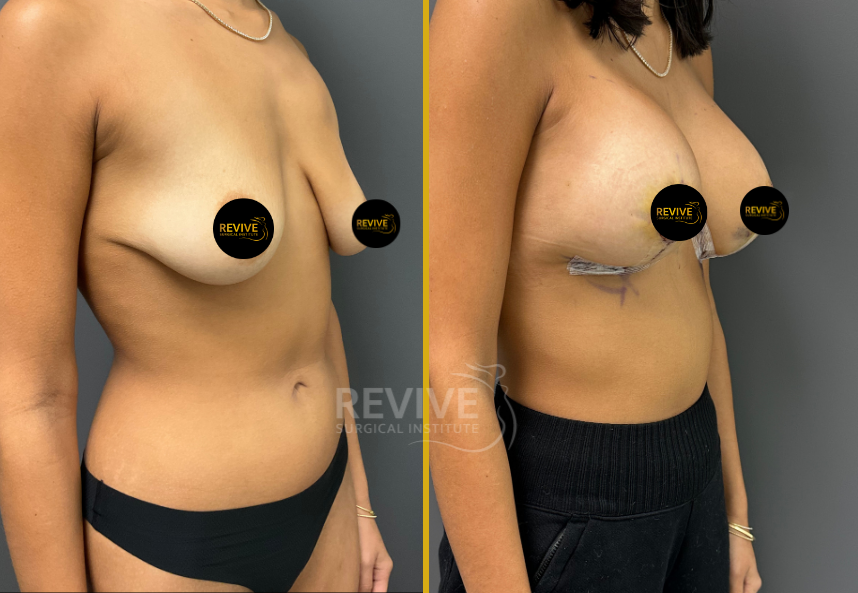 Breast Augmentation (5)