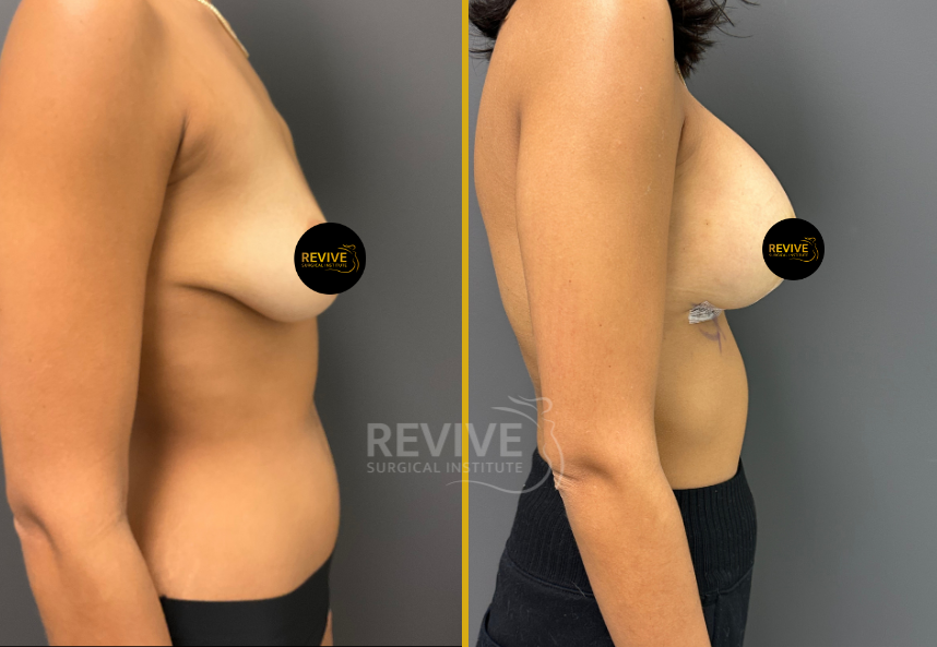 Breast Augmentation (6)