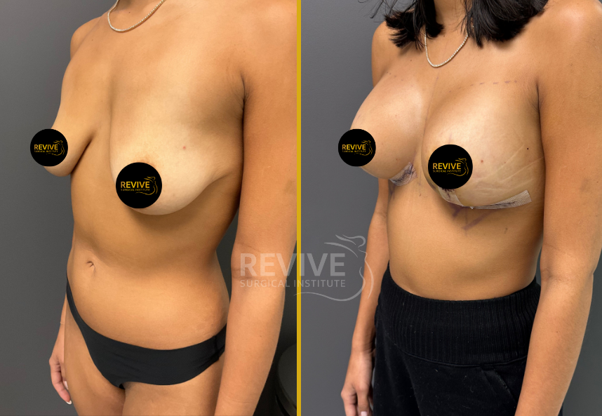 Breast Augmentation (7)