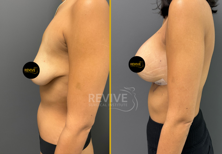 Breast Augmentation (8)