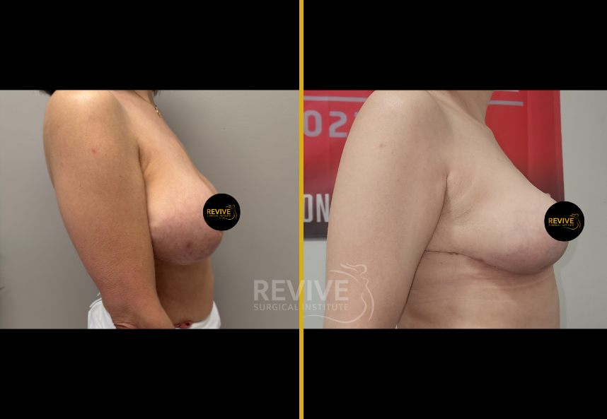 Before and after breast revision surgery, three-quarter view showing enhanced contour and lift