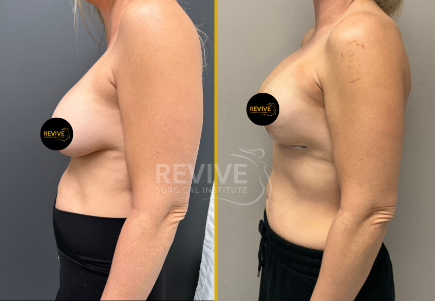 Before and after side view of breast revision showing improved breast shape and position