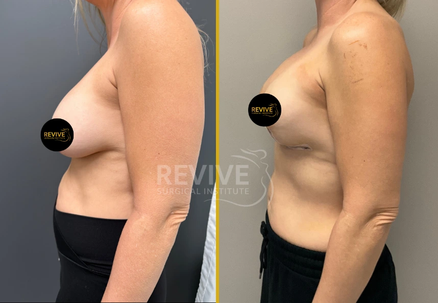 Before and after side view of breast revision showing improved breast shape and position