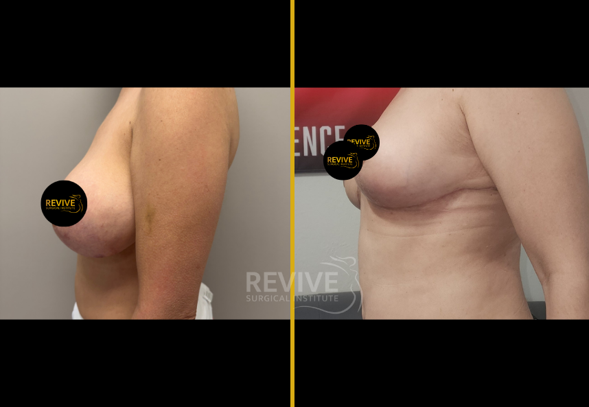 Before and after breast revision surgery, oblique side view showing improved shape and symmetry