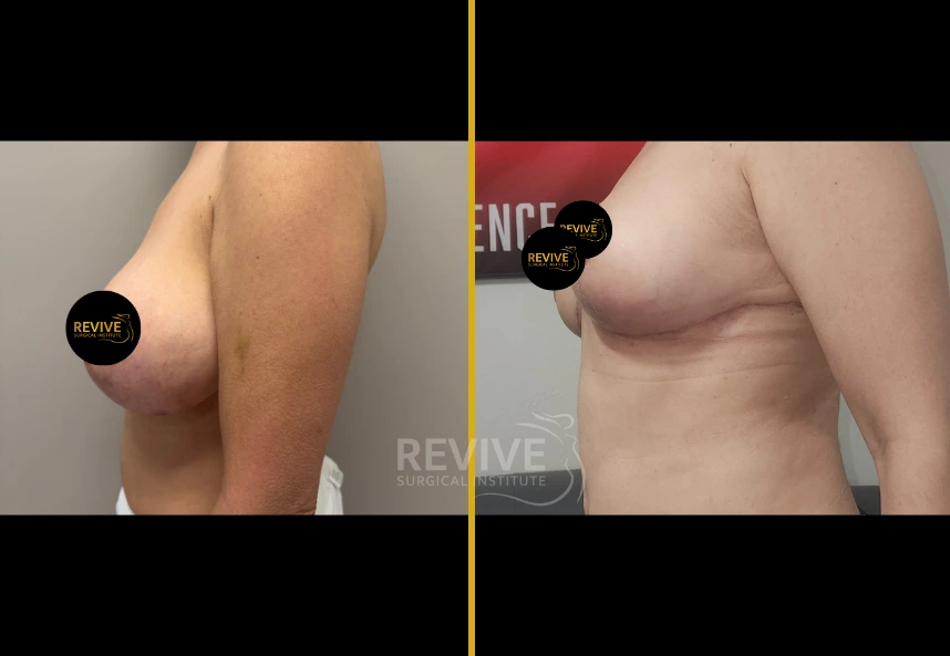 Before and after breast revision surgery, oblique side view showing improved shape and symmetry