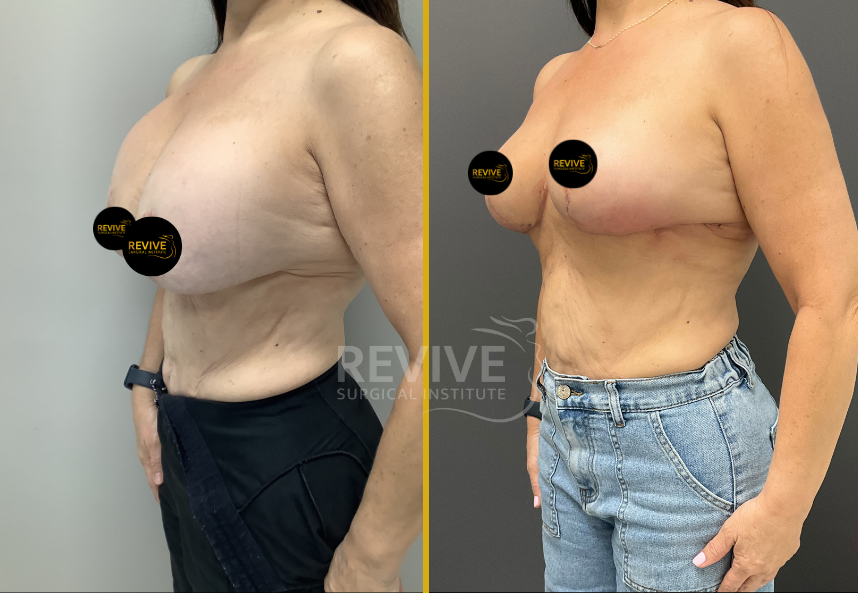 Before and after breast revision surgery, side view showing improved shape and upper pole fullness