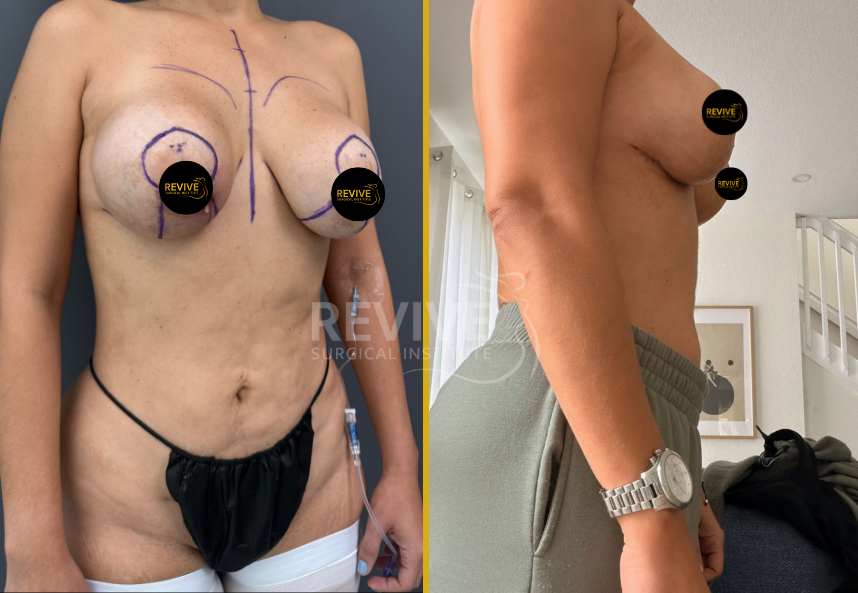 Before and after breast revision surgery, front and side views with surgical markings