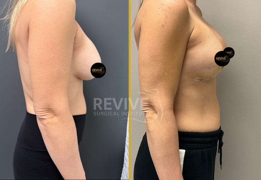 Before and after side view of breast revision showing enhanced breast contour and upper pole fullness