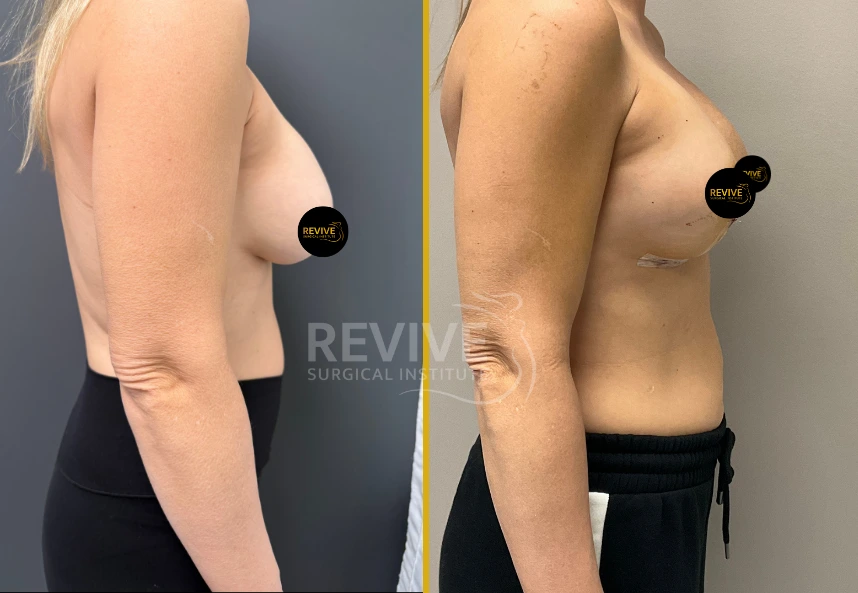 Before and after side view of breast revision showing enhanced breast contour and upper pole fullness