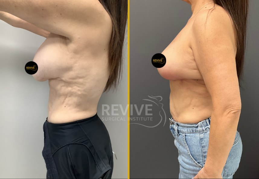 Before and after breast revision surgery, side profile showing enhanced lift and breast position
