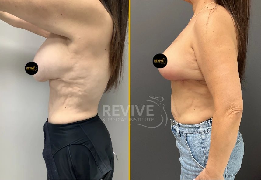 Before and after breast revision surgery, side profile showing enhanced lift and breast position