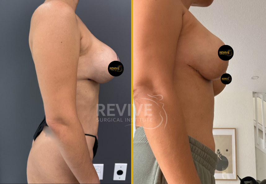 Before and after breast revision surgery, side profile comparison