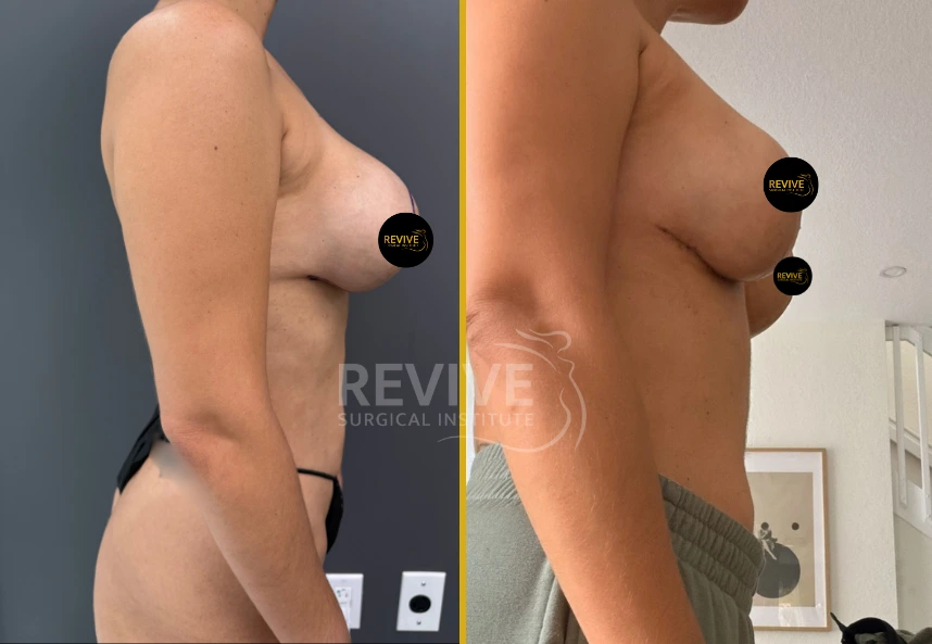 Before and after breast revision surgery, side profile comparison
