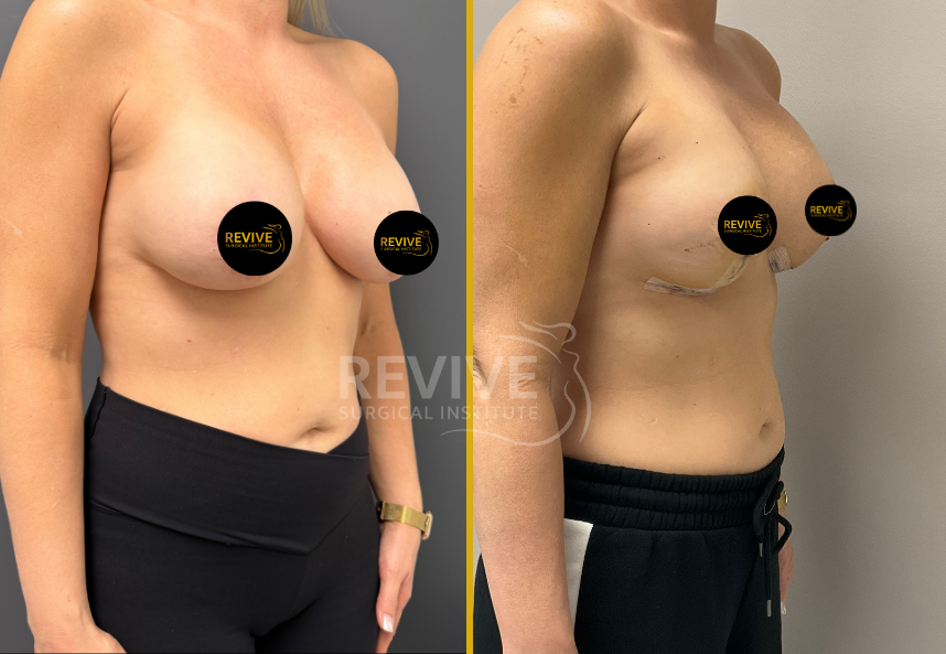 Before and after breast revision surgery, frontal view showing surgical changes and results