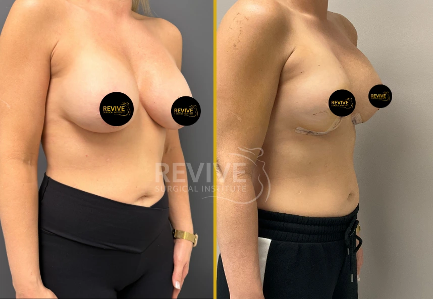Before and after breast revision surgery, frontal view showing surgical changes and results